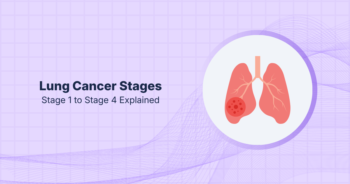 Lung Cancer Stages: Stage 1 to Stage 4 Explained